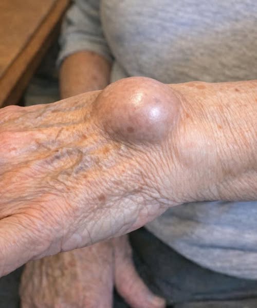 Doctors reveal that if you develop this strange lump on your wrist overnight, it means that you have …